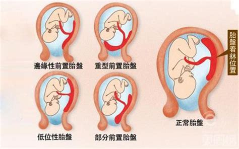 胎盤靠近子宮頸